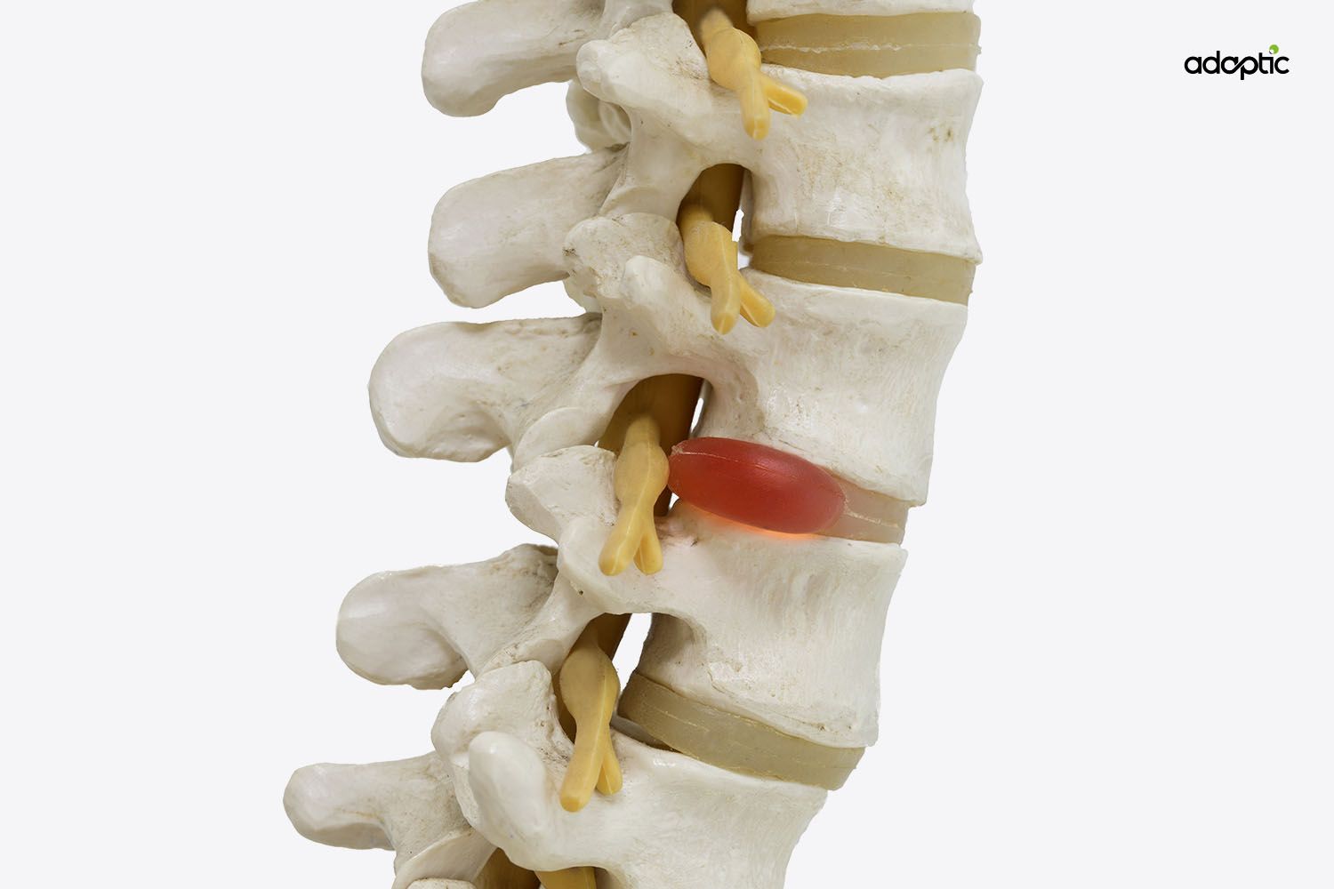 Hernia 